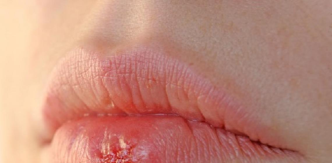 Krimbi i ziles: tiparet e sëmundjes dhe trajtimit