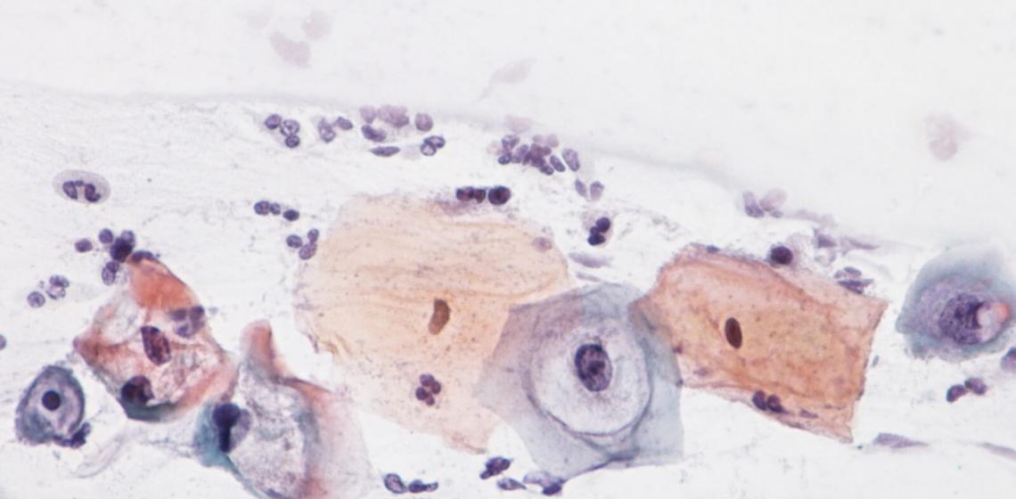 Ką reiškia netipinės ląstelės gimdos kaklelio tepinėlio citologija?