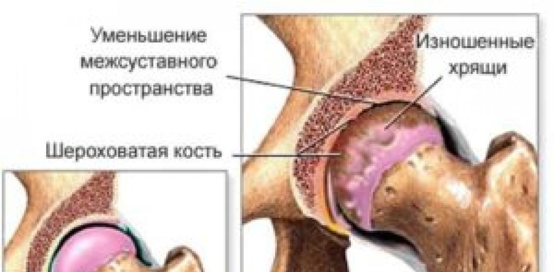Osteochondrosis muda pada punggung bukit: gejala, penyebab dan kekhasan pengobatan